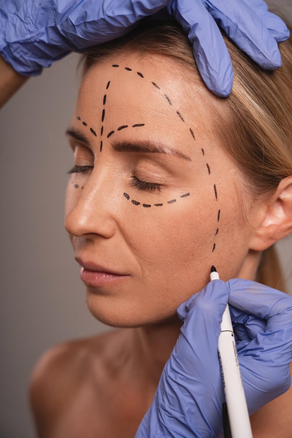 Preenchimento facial em SJC para suavizar bigode chinês e definir contornos com naturalidade.